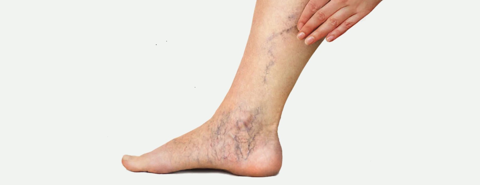 Varicose vein
