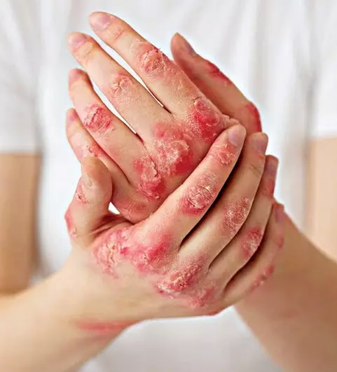 Allergy